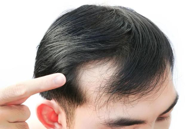 雍禾医疗，种得青丝难解愁(图1)